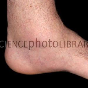 Tophus Natural - Living With Gout- What You Can Do To Decrease Symptoms And Pain