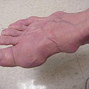 Curcumin Gout Cure - Gout Treatment Medicines Or Drugs And Their Side Effects