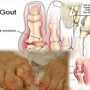  Figuring Out Gout Encounter Leads To?