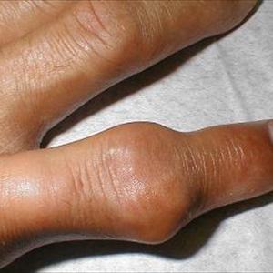 Gout Symptoms - Gout Relief, Ways To Get Relief From Gout