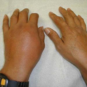 Gout Management - Arthritis--Can It Be Prevented?