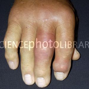 Gout Remedy Report - Common Forms Of Gout: Outlining Your Risk Factors