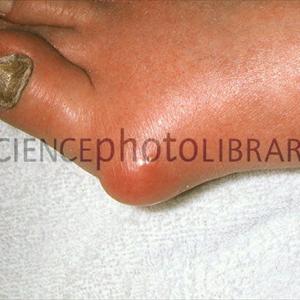 Turf Toe Gout - Looking For Natural Gout Cure? Try Cherry Juice As Cure For Gout