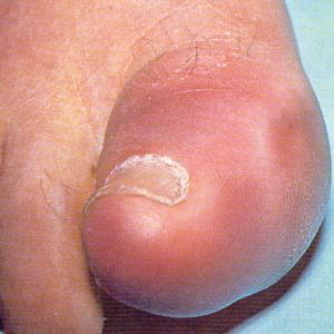  Calcaneal Fractures