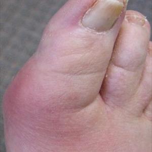 Natrual Gout Treatment - Discussion About Key Perform Of Vit C In Alleviation Of Gout