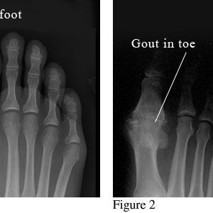 Severe Gout - Instant Gout Pain Relief With Baking Soda