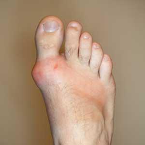 Gout Remedy Report - Common Forms Of Gout: Outlining Your Risk Factors