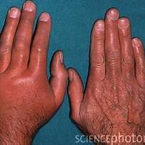 Acupressure Diet Rings - Gout Symptoms