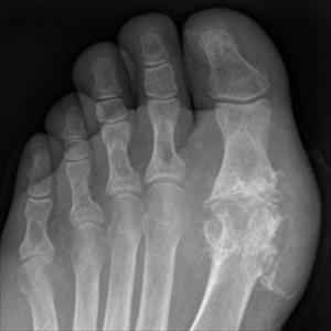  Alcohol And Gout 