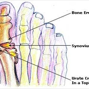  Various Symptoms Of Gout