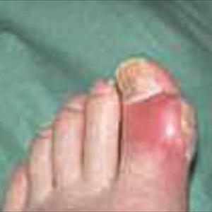 Wikipedia Gout - Symptoms And Treatment For Gout Or Joint Swelling