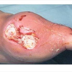 Acid Uric Diet 