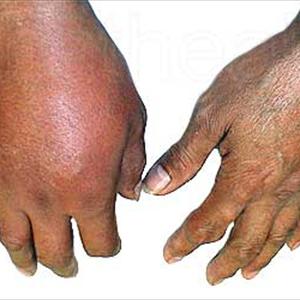 Relief From Gout - Calcaneal Fractures