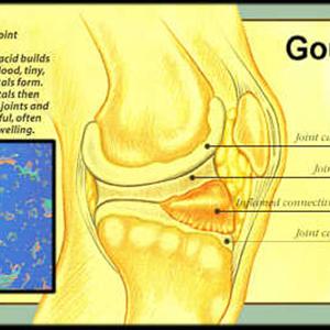 Gout Natural Remedies - Discovering The Best Gout Diet