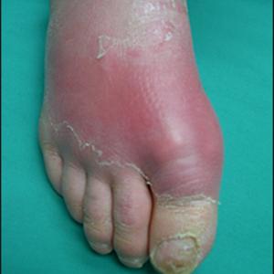 Tomatoes And Gout - Plantar Faciitis And Heel Pain Causes