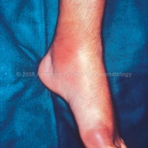 Penyakit Gout - What Happens When Uric Acid Increases?