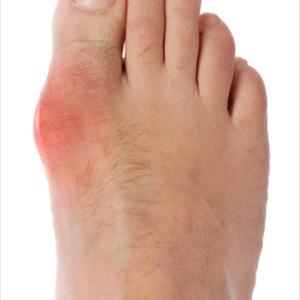 Gout Home Remedies - Osteoarthritis