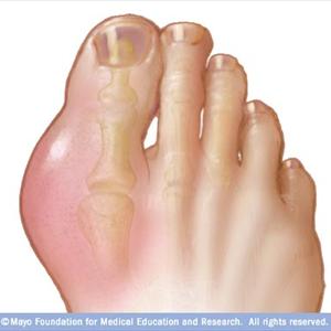 Uric - What Things To Ward Off Along With Gout Diet Programs